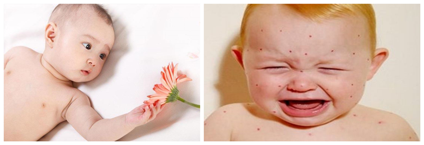 兒童濕疹反反復復，您有在家安裝家用除濕產品嗎？